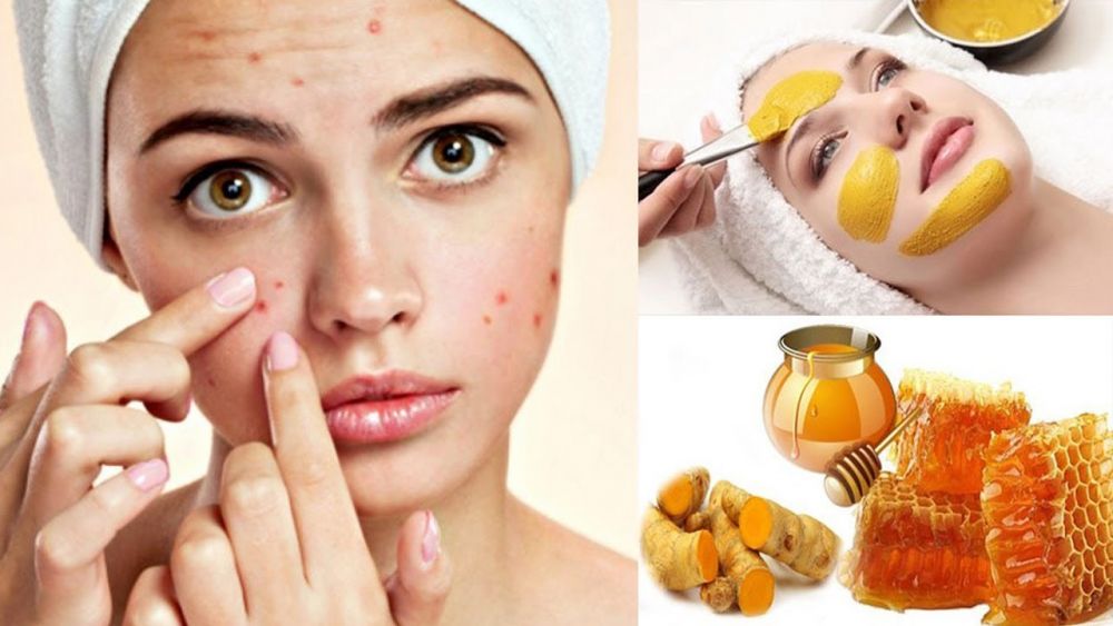 Cách Trị Sẹo Thâm đỏ Bằng Mật Ong