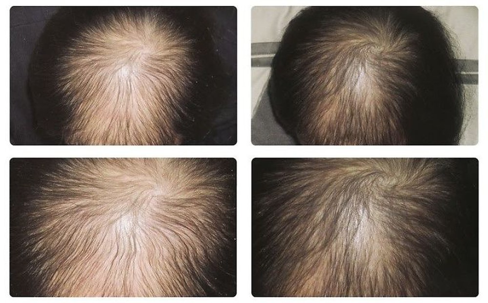 Hình ảnh so sánh trước và sau khi dùng tinh dầu bưởi