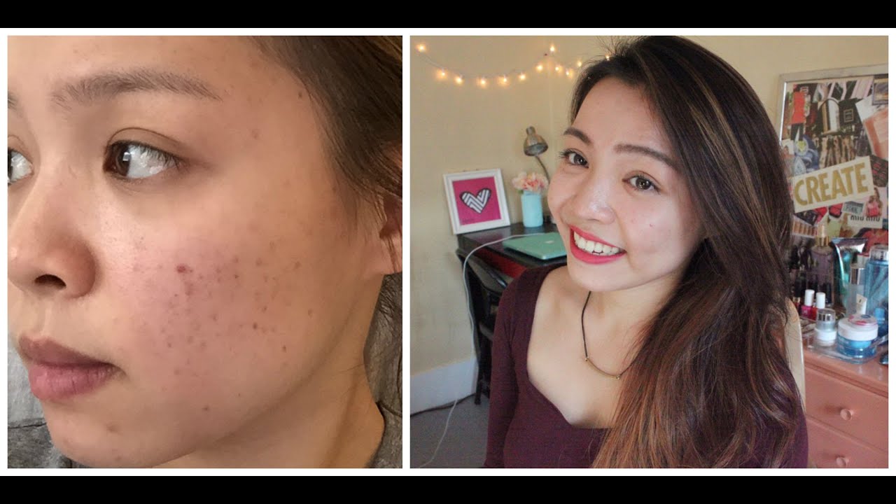 Review Sản Phẩm Trị Thâm Mụn Hiệu Quả - How to Get Rid Of Acne ...