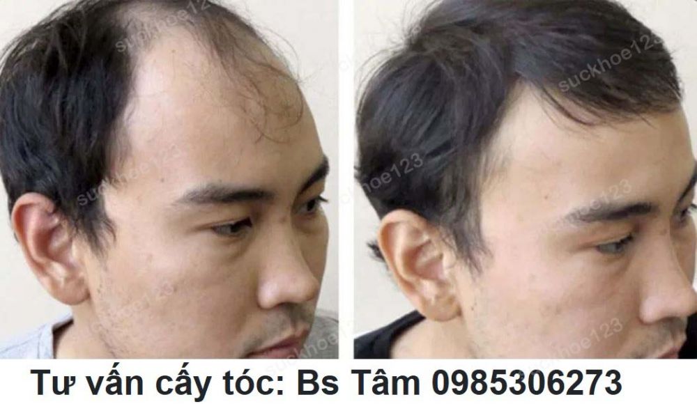 Cay Toc Bac Si Tam Ca 1
