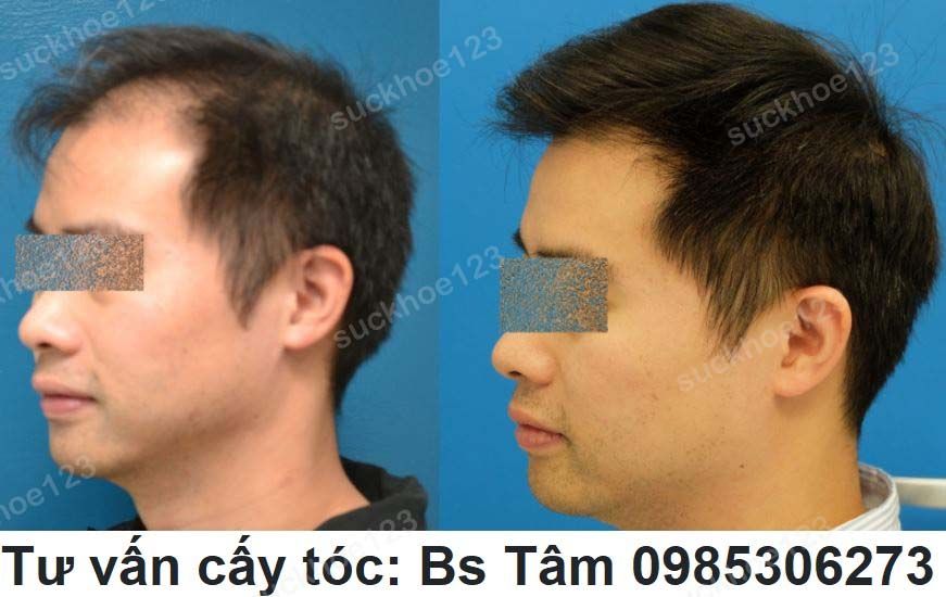 Cay Toc Bac Si Tam Ca 2 3