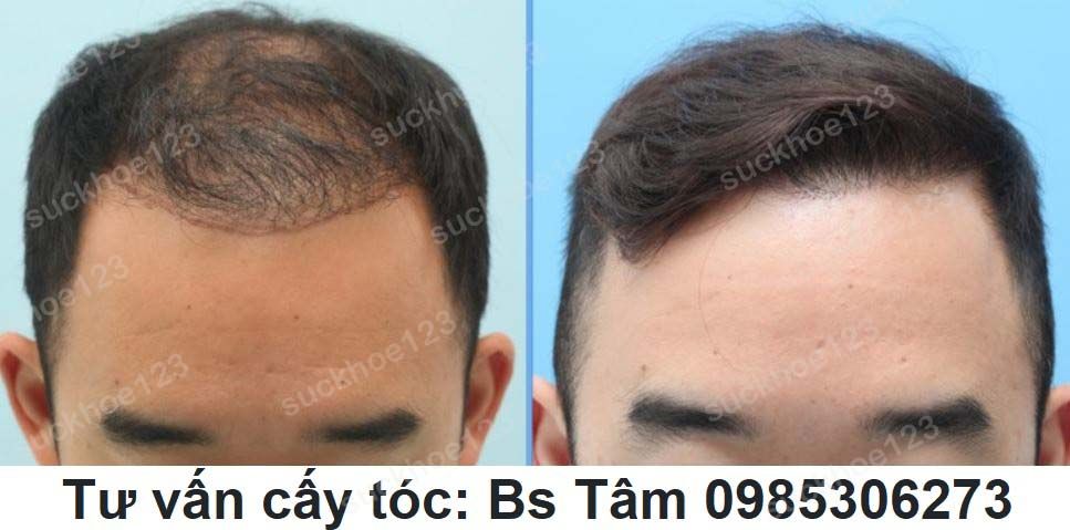 Cay Toc Bac Si Tam Ca 3