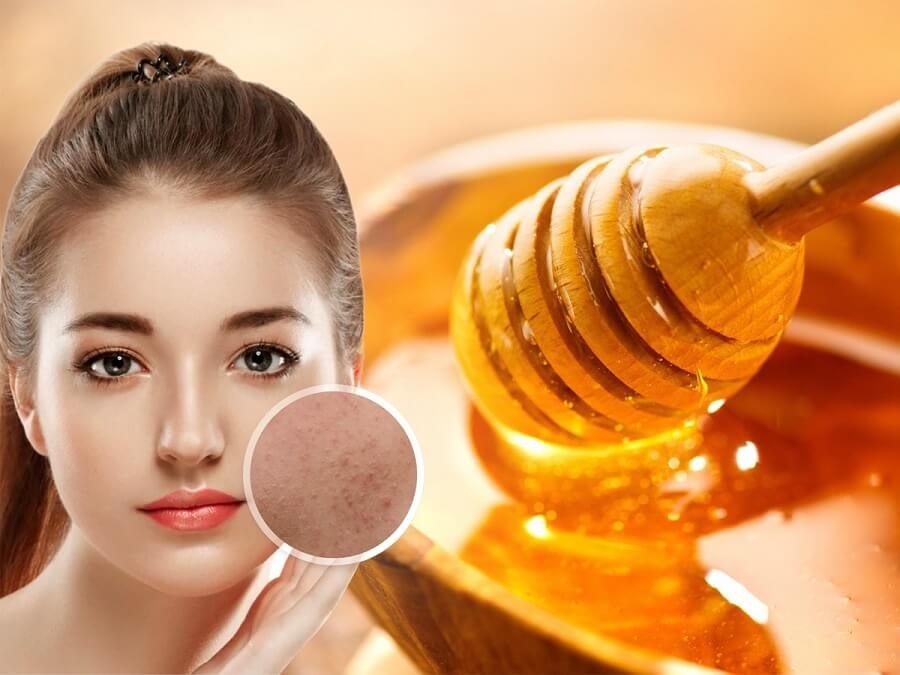 7 cách trị mụn ẩn dưới da bằng mật ong ít ai biết?