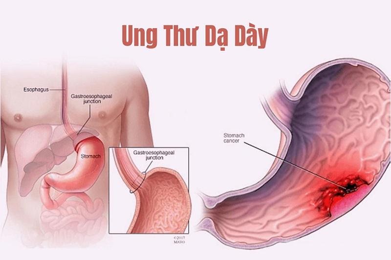 Dạ dày: Vị trí, cấu tạo, vai trò, chức năng, các bệnh thường gặp