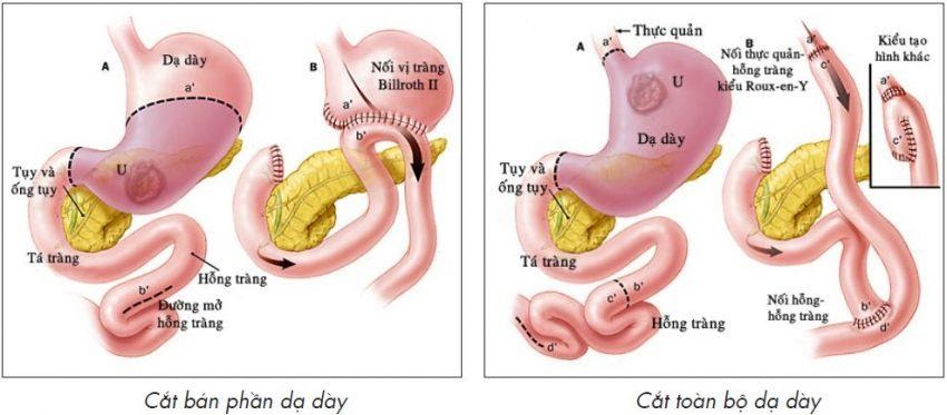 Phẫu thuật cắt dạ dày - Bệnh Viện FV