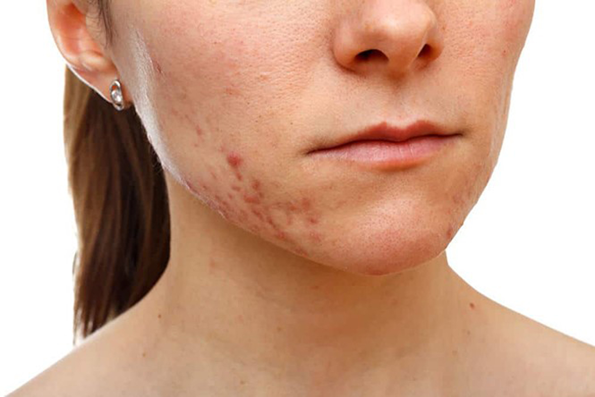 Serum mờ thâm mụn