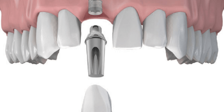 Cay Ghep Implant 1