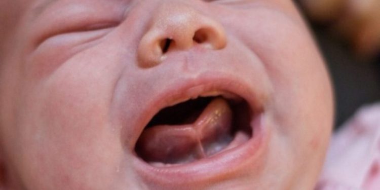 trẻ sơ sinh bị dính thắng lưỡi