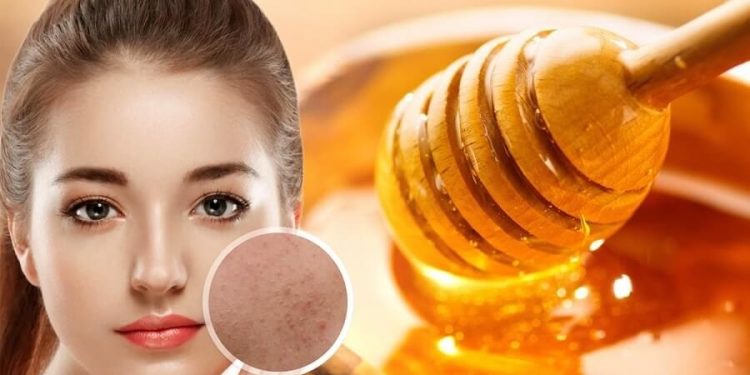 7 Cách Trị Mụn ẩn Dưới Da Bằng Mật Ong ít Ai Biết?