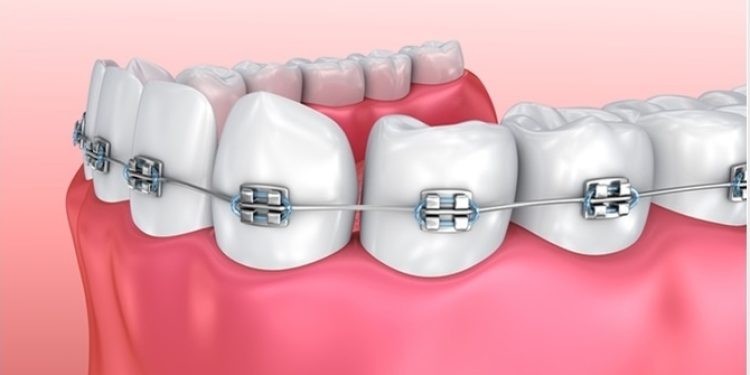 địa chỉ niềng răng uy tín